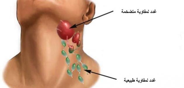 اسباب انتفاخ الغدد اللمفاوية , اسباب مخيفة لتورم الغدد اليمفاوية