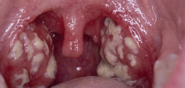التهاب اللوزتين بالصور - اوجاع اللوزتين