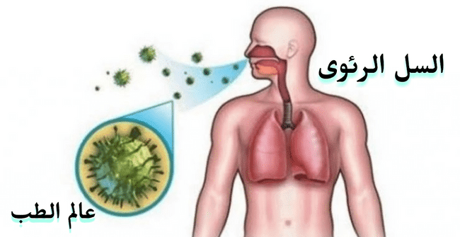 علاج مرض السل