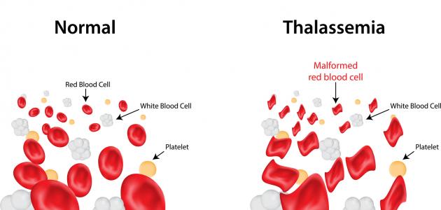 مرض الثلاسيميا - معلومات قيمه عن مرض الثلاسيميا 1635 3
