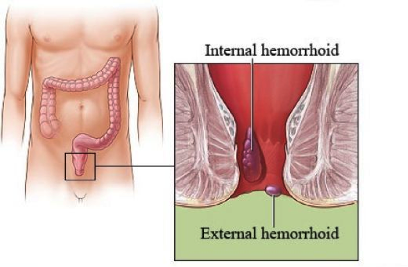 اسباب البواسير , معلومات مهمة عن البواسير
