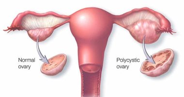 اعراض مرض تكيس المبايض