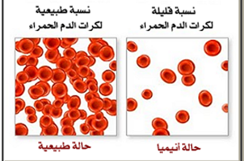 مرض فقر الدم - علاج فقر الدم واعراضه 1283
