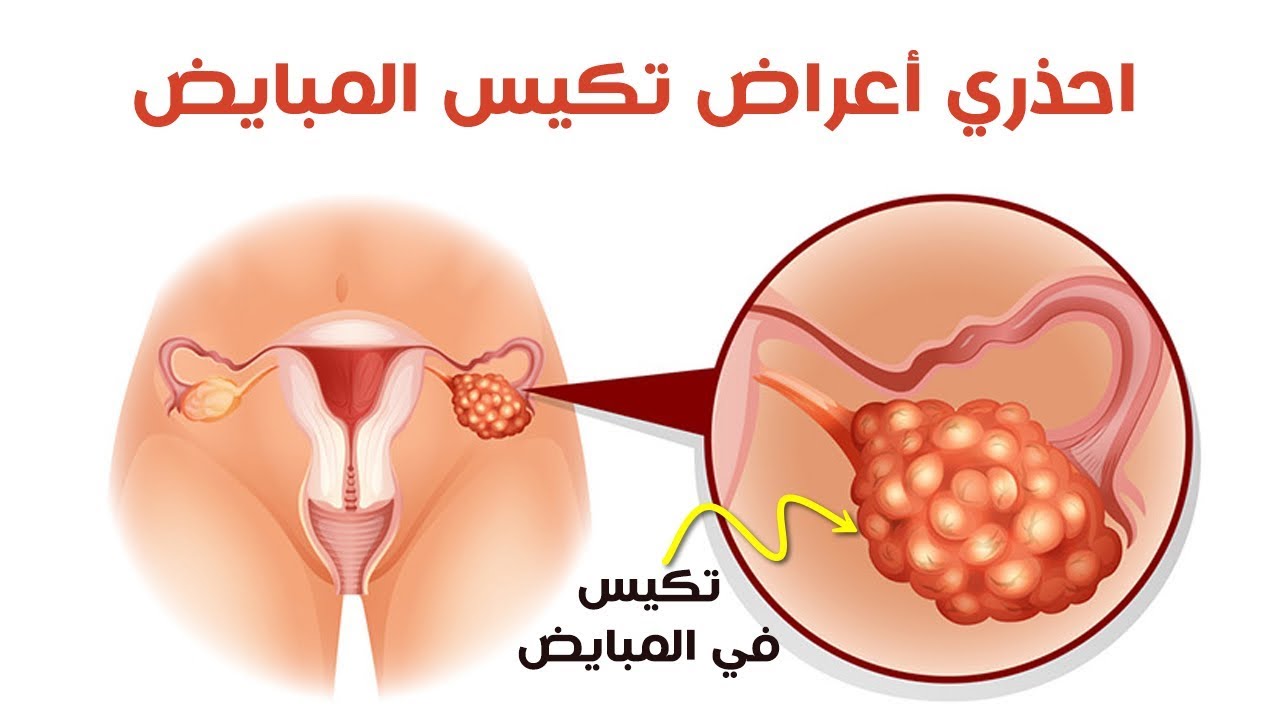 ماهي اعراض تكيس المبايض , امراض المراه