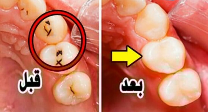 علاج تسوس الاسنان