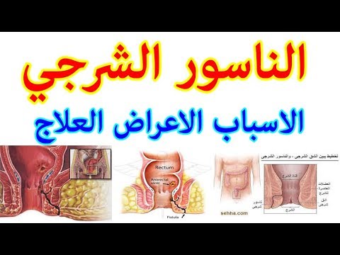 ما هو الناسور - اعراضه و كيفية علاجه 0 13