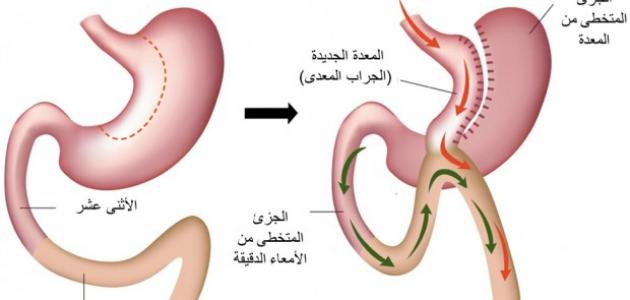 عملية تحويل المعدة