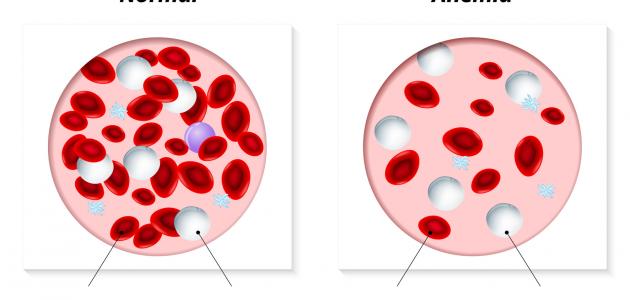 مرض فقر الدم - علاج فقر الدم واعراضه 1283 1