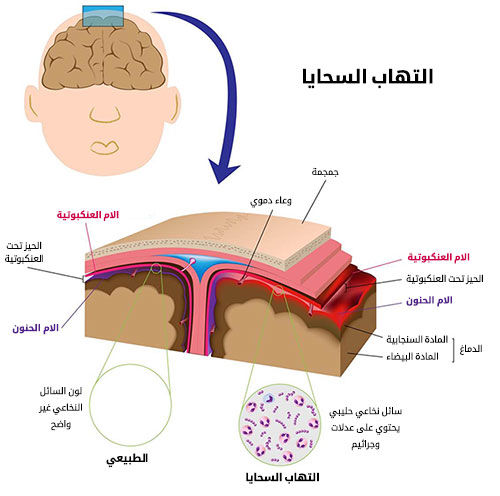 مرض السحايا- ماهو مرض السحايا 5491 8