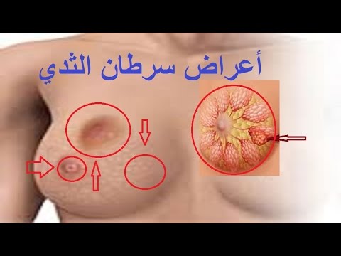 اعراض سرطان الثدي , الاصابة بسرطان الثدي وكيف يتم علاجه