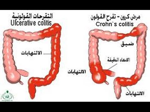 مرض القولون , اعراض القولون وطرق العلاج السريعه