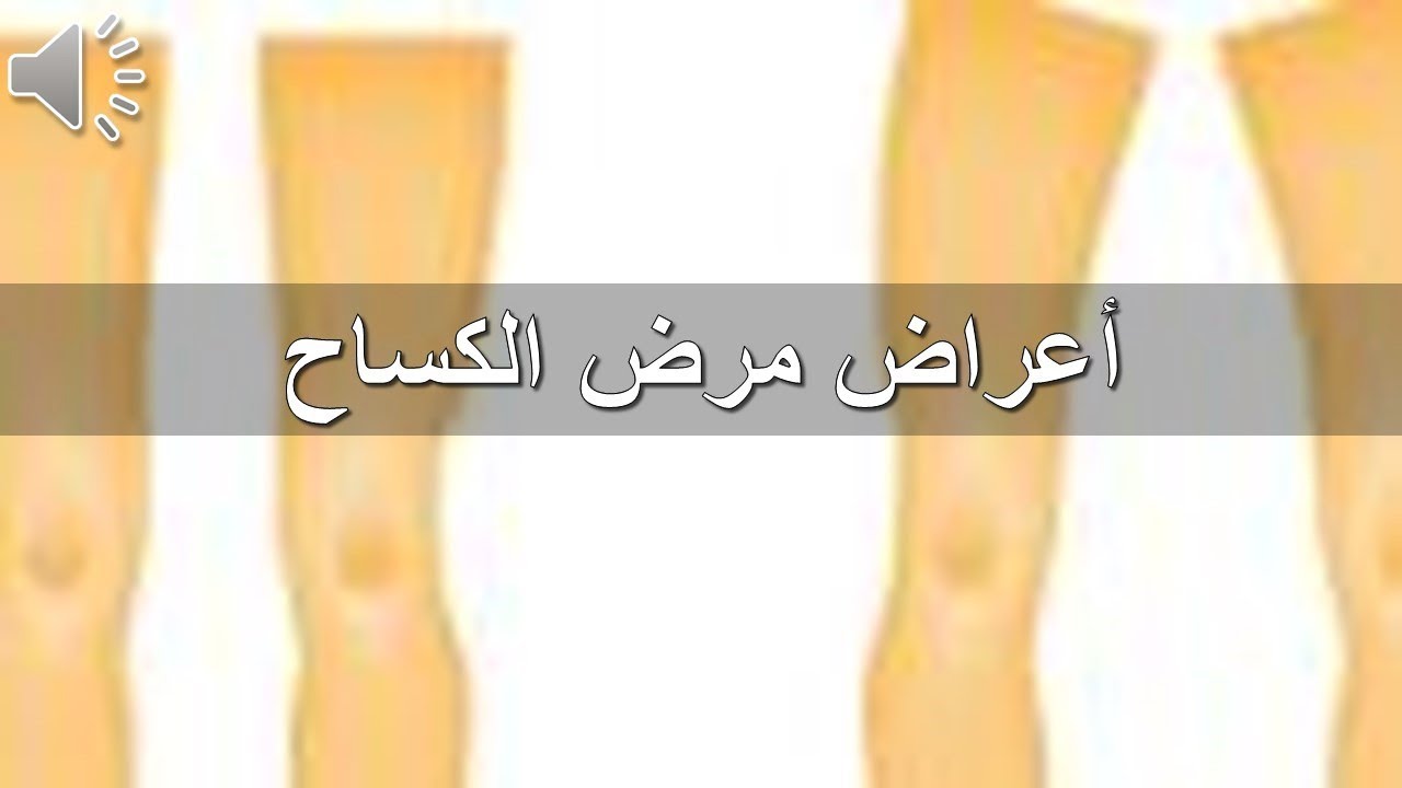 مرض الكساح , تعرف على اسباب وعلاج مرض الكساح