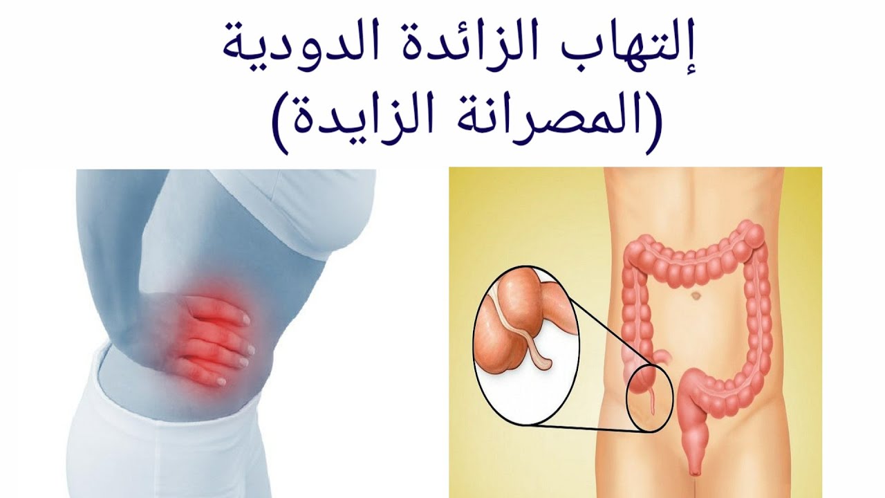 اعراض الزائدة الدودية - معلومات طبية 3991 2