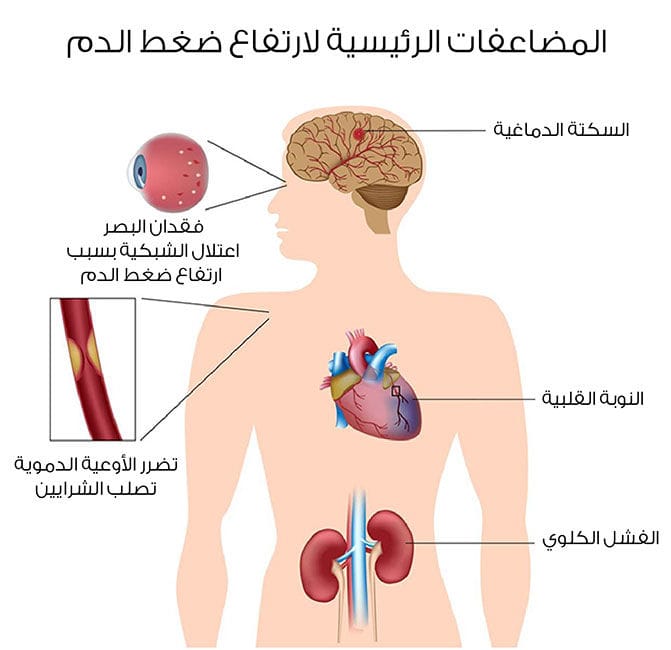 علاج ارتفاع ضغط الدم - اسباب ارتفاع الضغط وعلاجه 1384 2