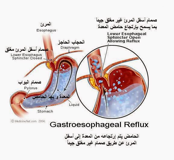 عسر الهضم , اسباب صعوبة الهضم