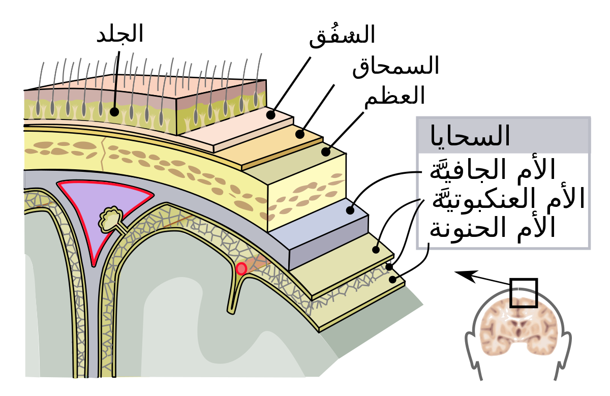 مرض السحايا- ماهو مرض السحايا 5491