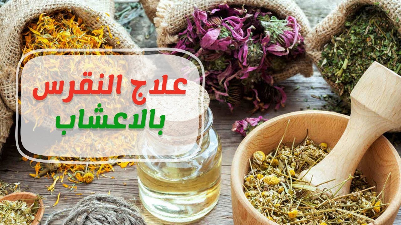 علاج النقرس بالاعشاب - كيفيه علاج النقرس بالاعشاب 404 3