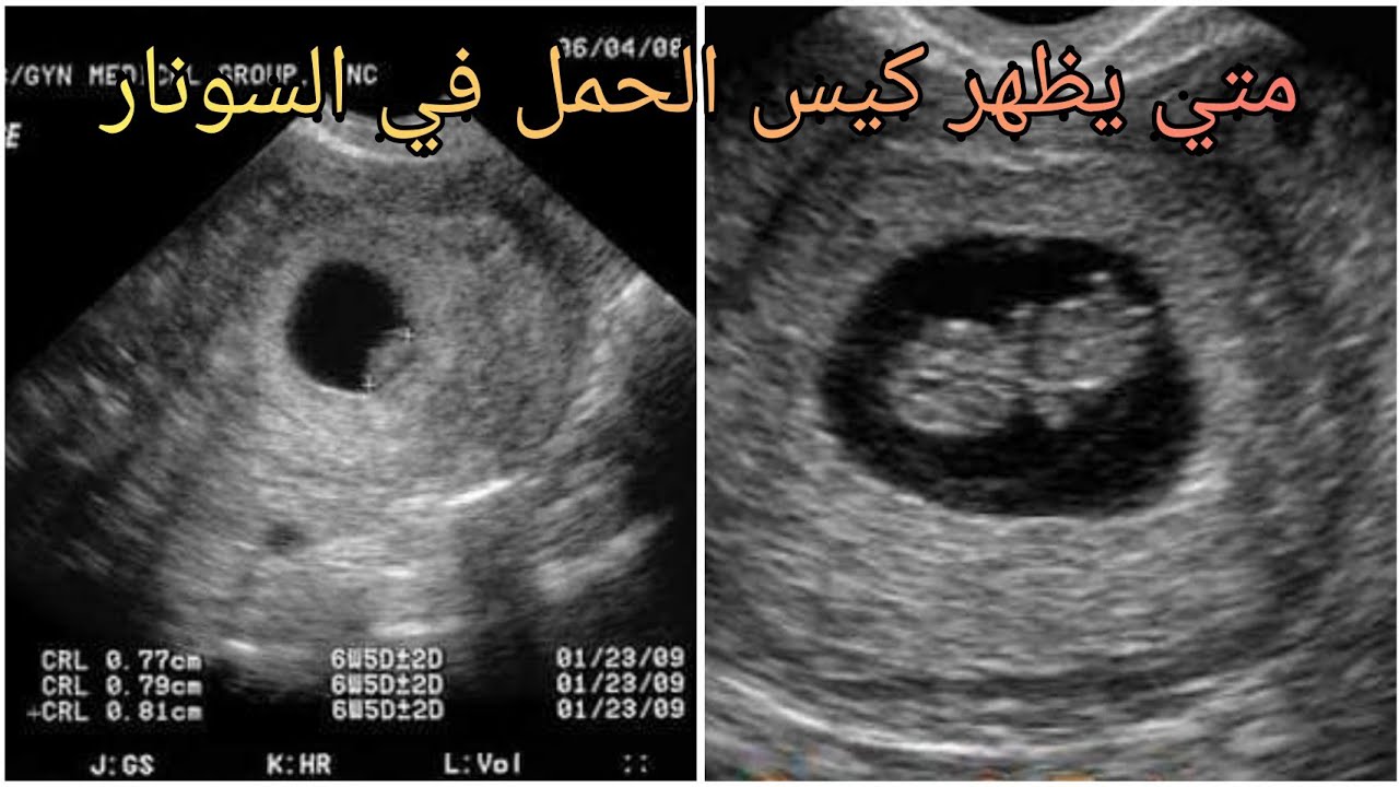 متى يظهر كيس الحمل بالسونار , موعد ظهور الحمل في السونار