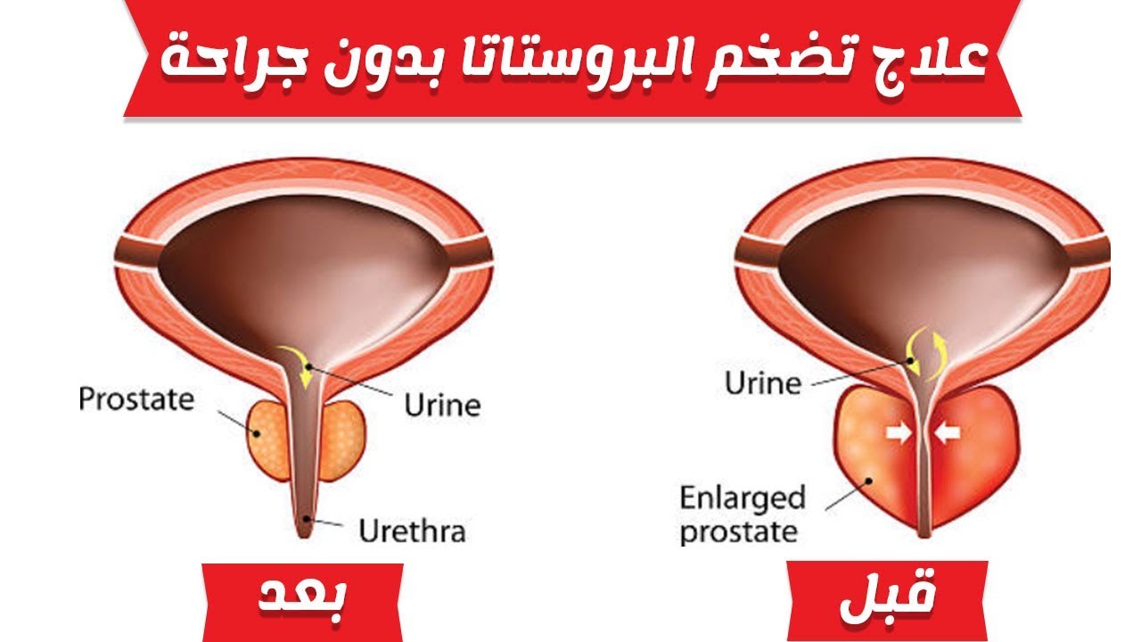 علاج تضخم البروستاتا , علاج البروستاتا بالثوم