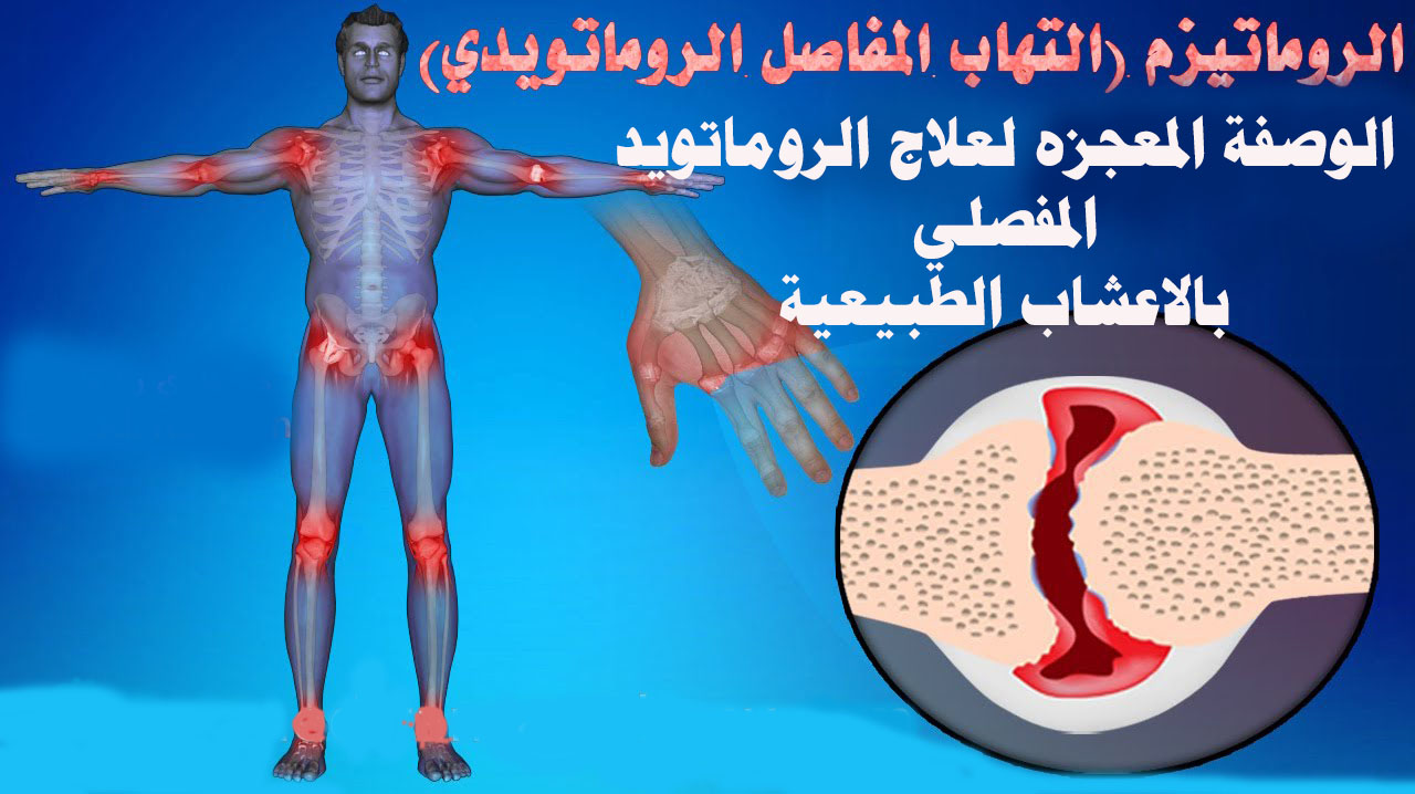 علاج التهاب المفاصل الروماتيزمي بالاعشاب