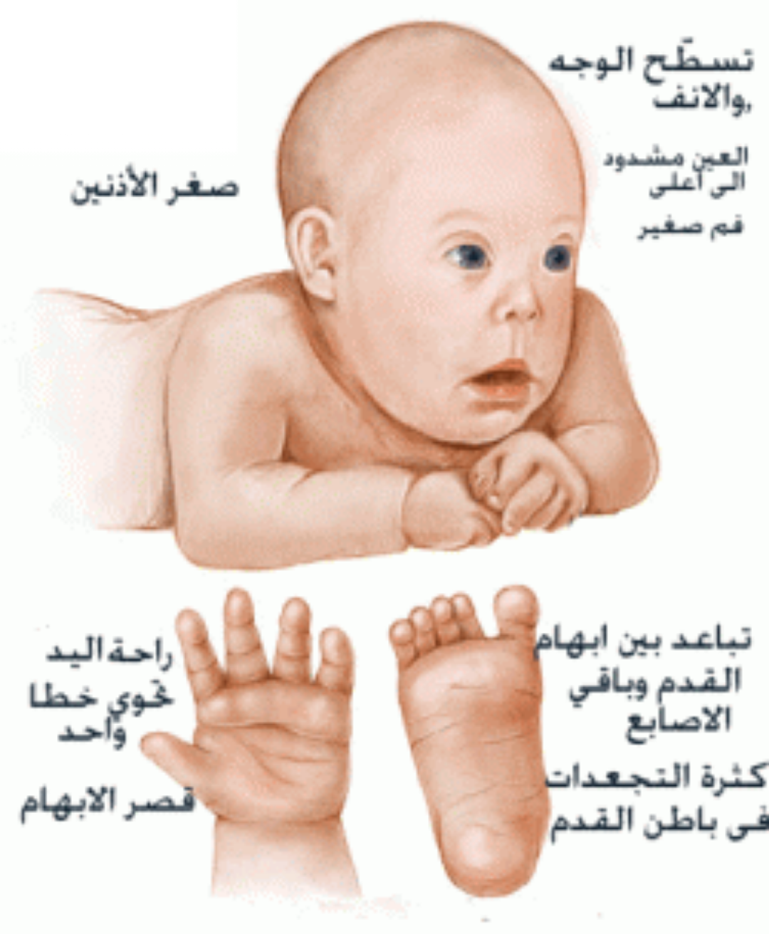Синдром Дауна у новорожденных